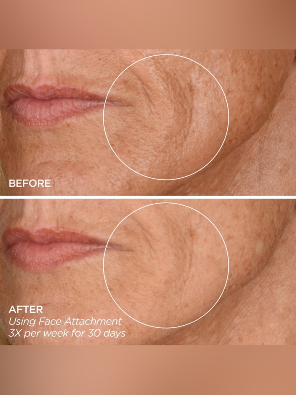 BNIP- GloPRO Microneedling Tool and Tru Face Line Corrector Kit - Picture 6 of 16
